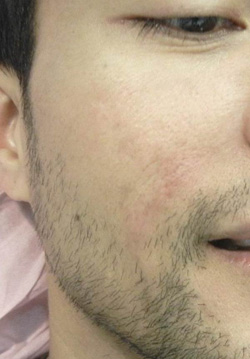 M Khan: Acne scars  after