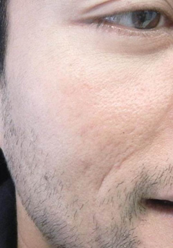 M Khan: Acne scars  before