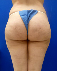 After Cellulite (Saddle Bags) Surgery 