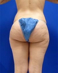Before Cellulite (Saddle Bags) Surgery 