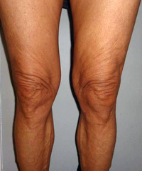 After Knee Contouring