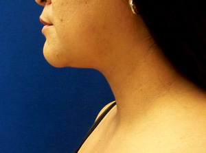 After Neck Liposuction 