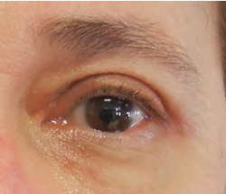 M Khan: Correction of droop on the outer corner of the eye  after