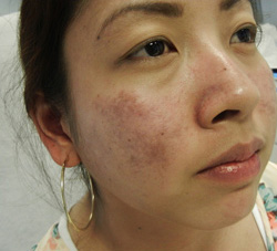 M Khan: Lupus Scarring before