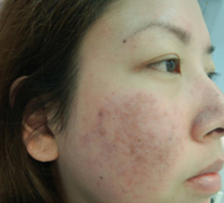 M Khan: Lupus Scarring after