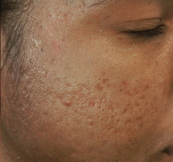 M Khan: Acne scars: before