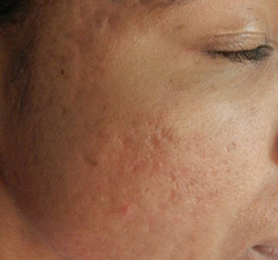 M Khan: Acne scars: after
